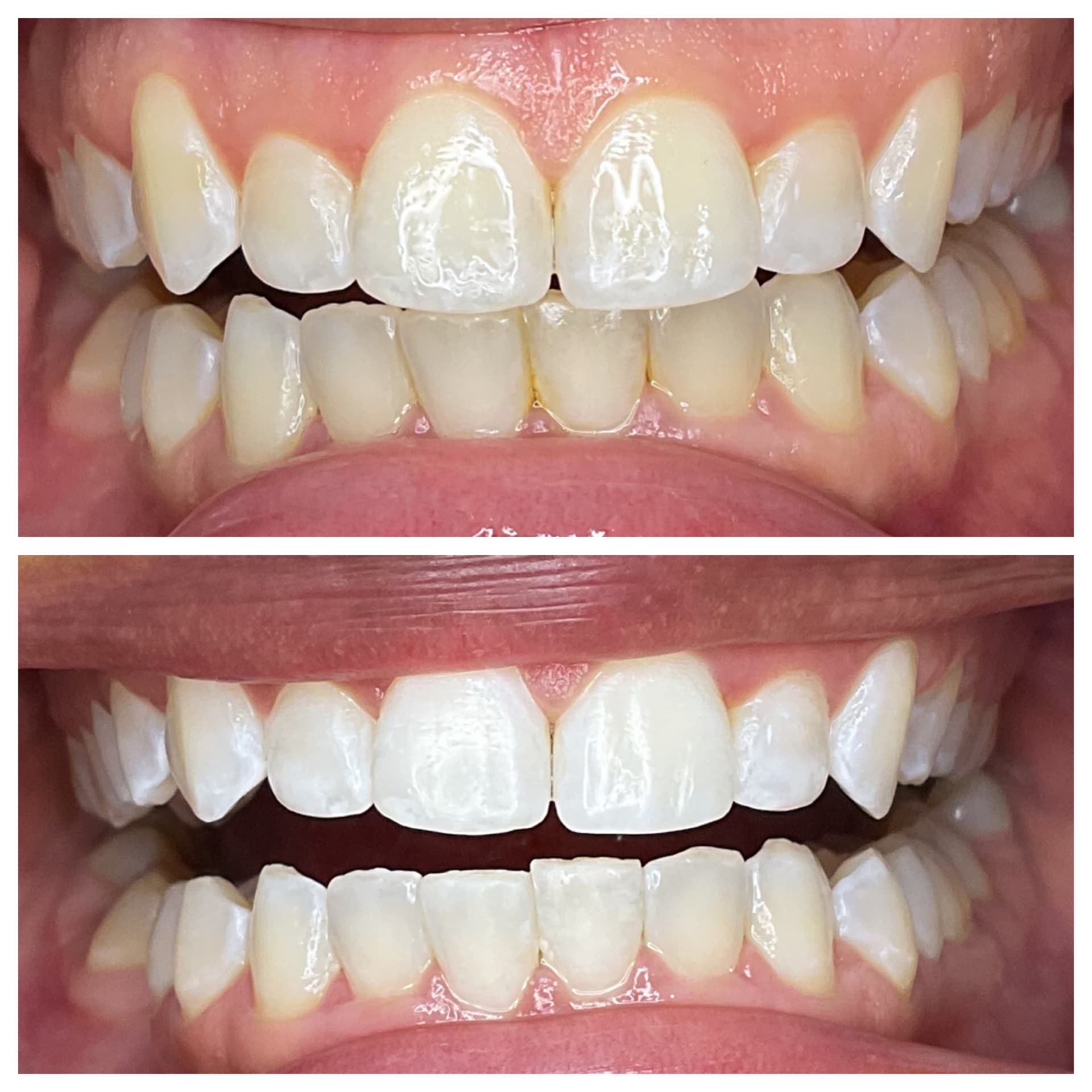 Teeth whitening before and after results — noticeably brighter smile, SmileSpark Henderson NV