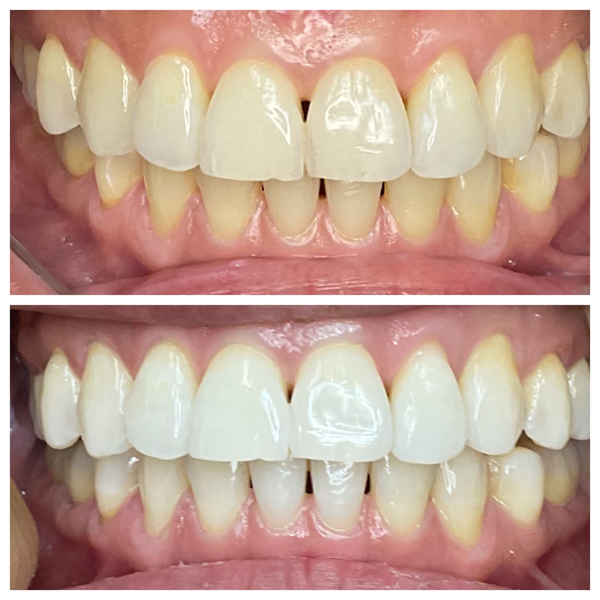 Teeth whitening before and after results — dramatic same-day whitening, SmileSpark Henderson NV