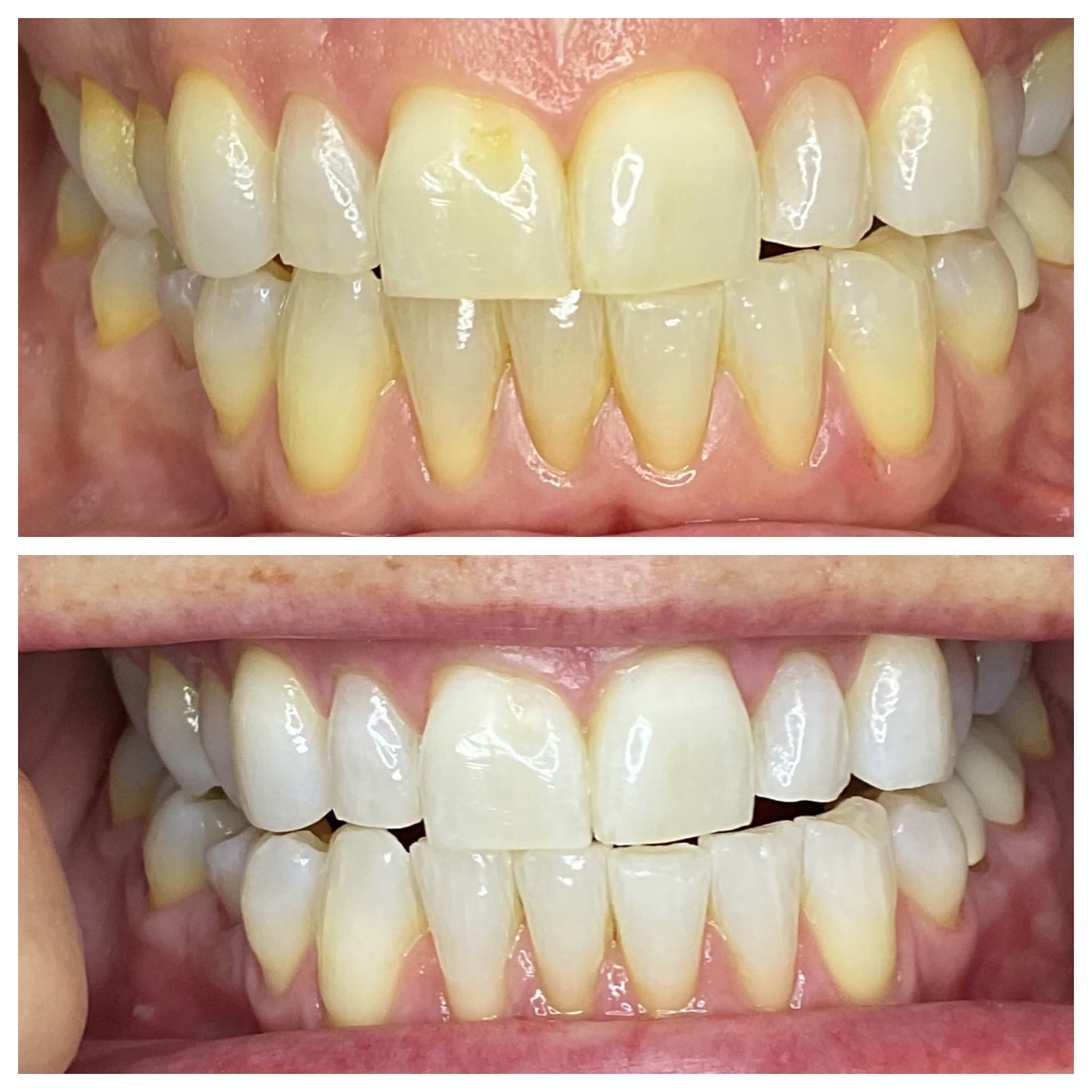 Teeth whitening before and after results — real client whitening results, SmileSpark Henderson NV